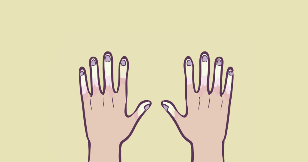 hands showing Raynaud's